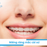 Niềng Răng Mắc Cài S